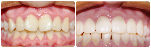 Teeth Crowded