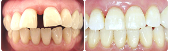 Wide Gap Between Teeth