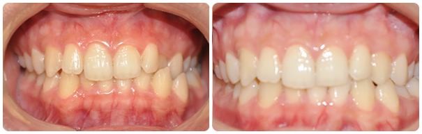 Underbite
