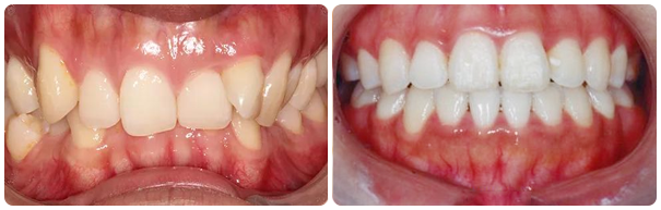 Deep Overbite