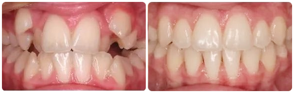 Buck Teeth